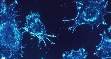 Liposuction Shows Promising Signs for Cancer Suffers With Lymphoedema