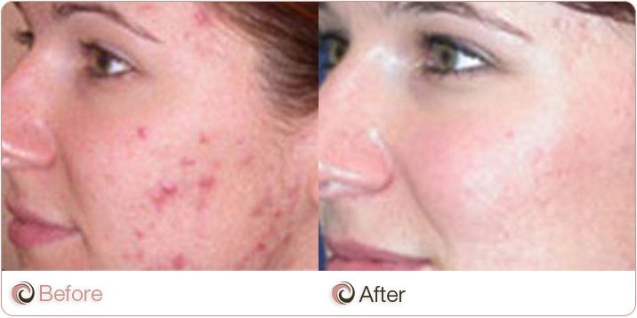 Acne Treatment Before & After | Cosmos Aesthetics