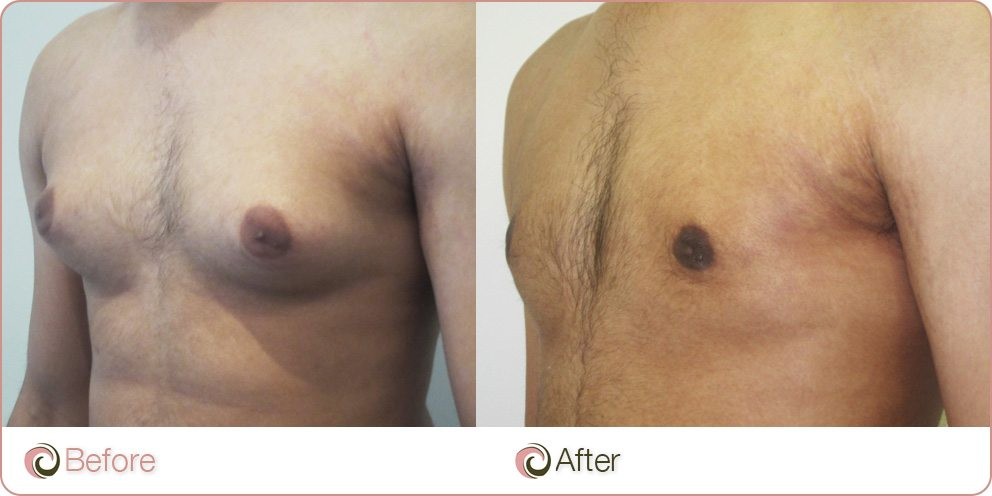 Man Boobs Liposuction Before and After Photo