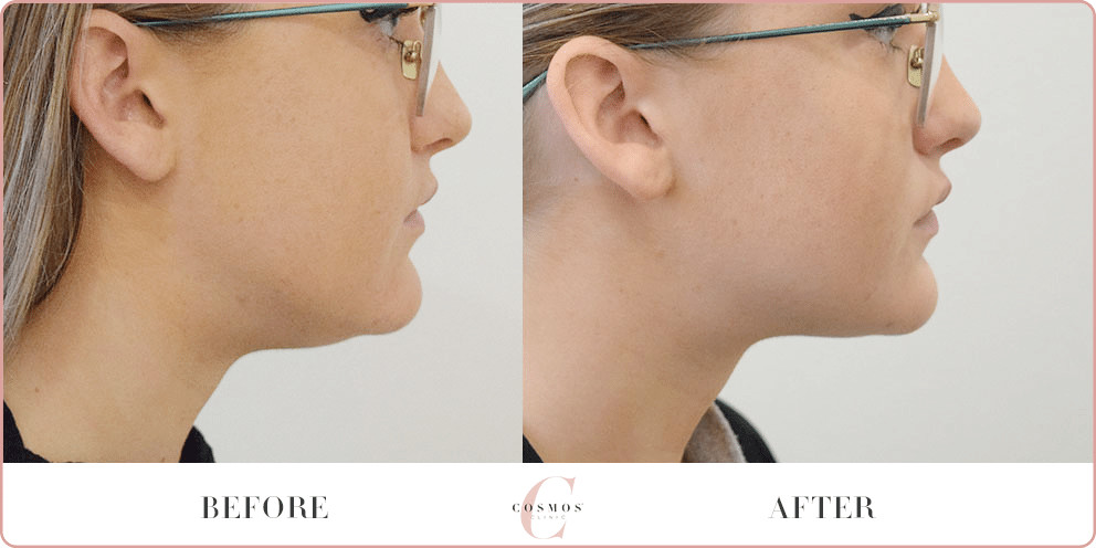 treating double chin with Coolsculpting 