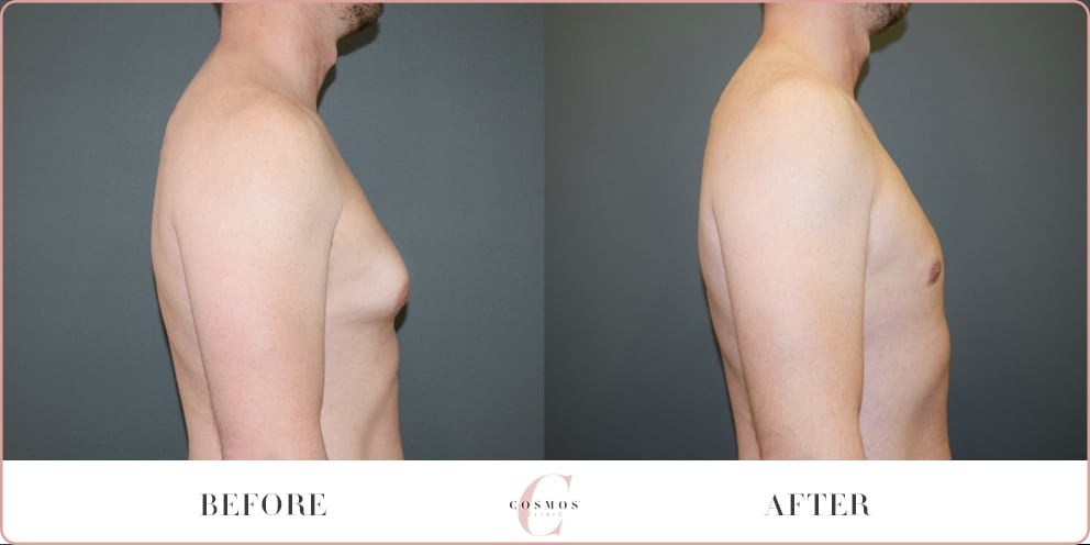 Male breast reduction at Cosmos Clinic, patient AS before & afters 03, side view