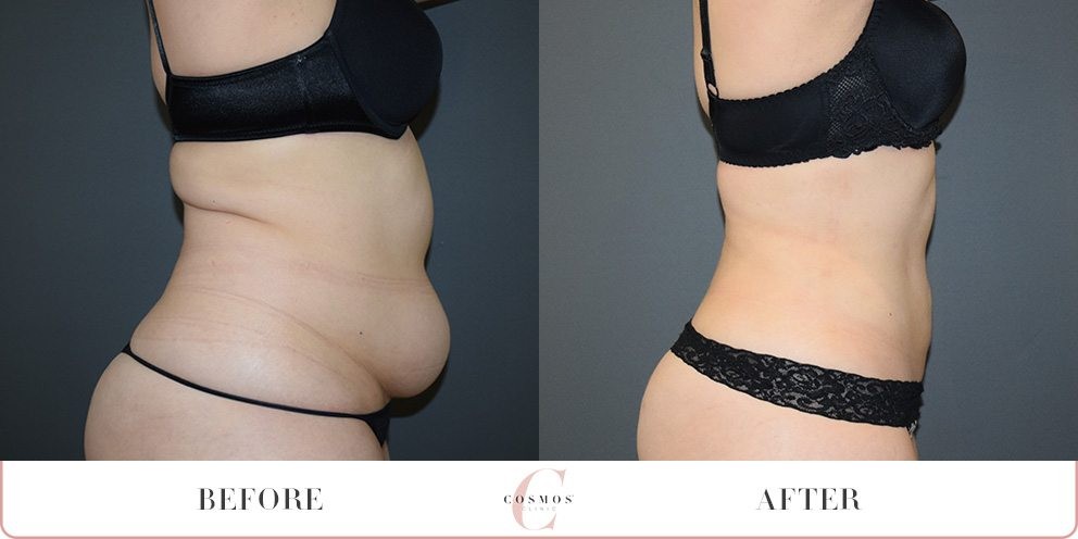 Vaser Liposuction Before & After.