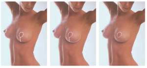 Types of breast scars after surgery