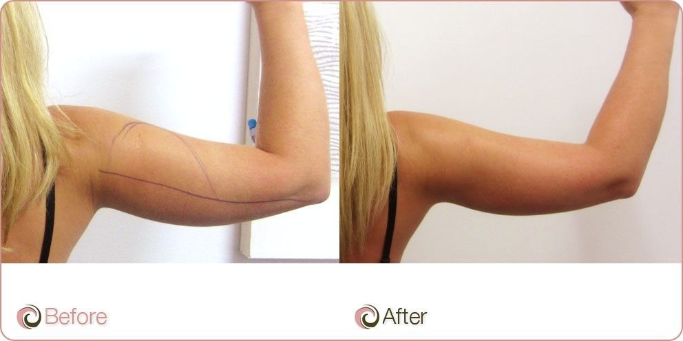 Arm Liposuction Before  After  Cosmos Clinic