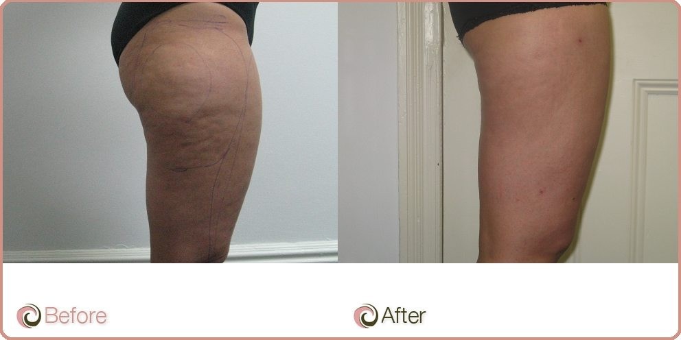 Cellulite Treatment before and after 4 weeks! Incredible Transformation is  waiting for you, the patient already tried 50 cellulite sessio