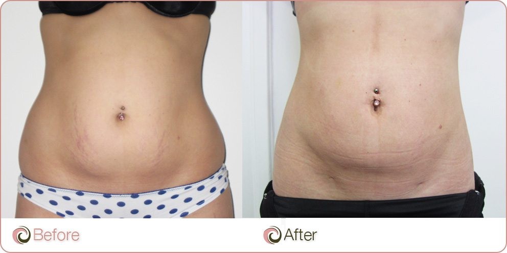 Stretch Marks Before And After