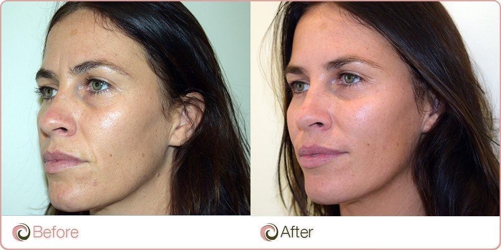 Dermal fillers before and after photo