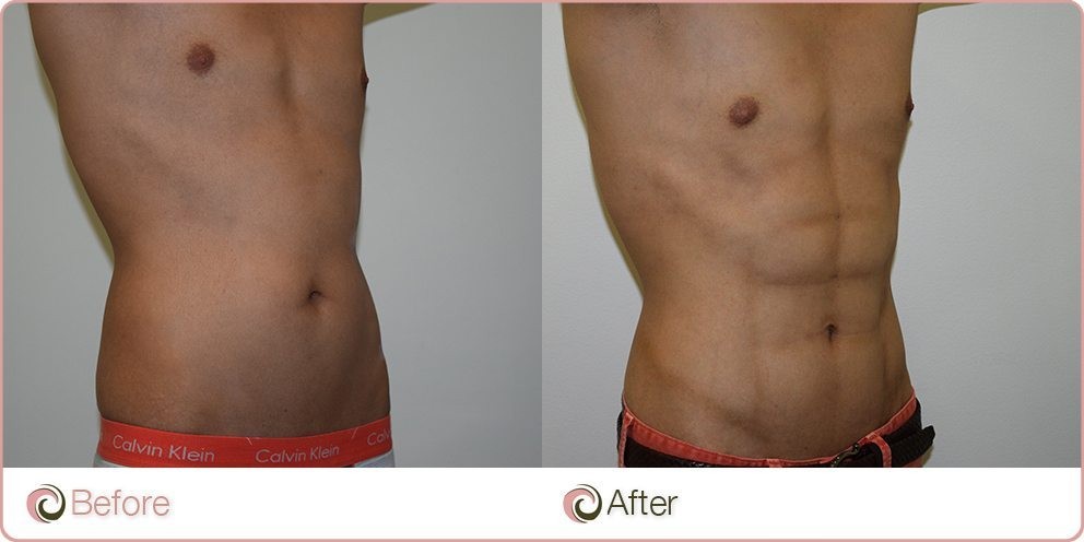 How Much Fat Can Liposuction Safely Remove