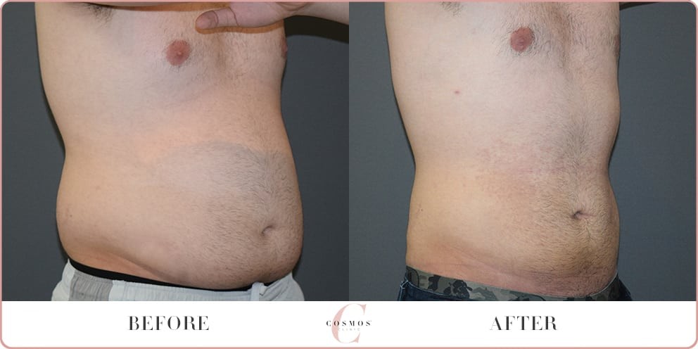 Mega Liposuction Before & After - Explore Our Procedures