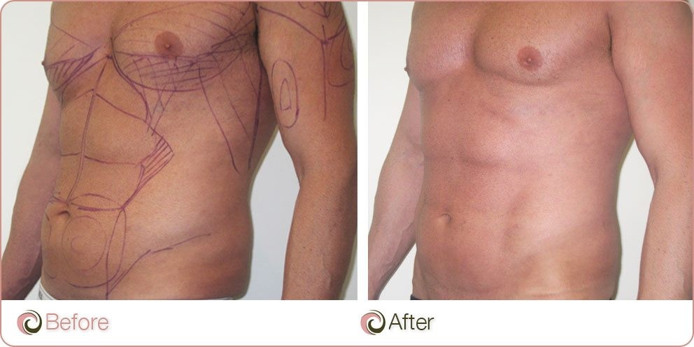 Male Vaser Hi Definition Liposuction Before & After.