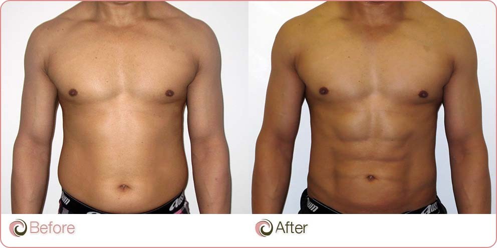 VASER Hi-Def Liposuction before and after photo