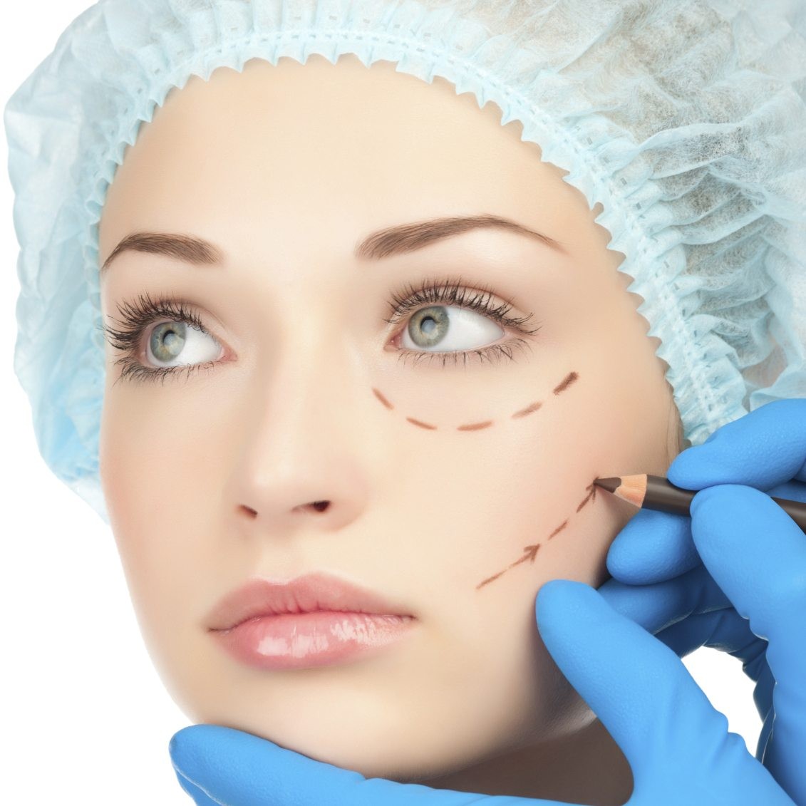 Silhouette Soft Face Lift Before & After Cosmos Aesthetics