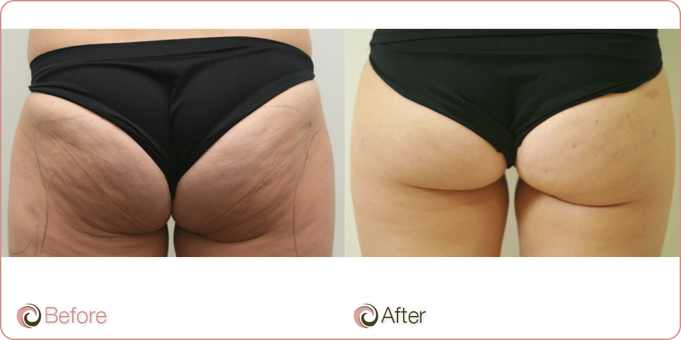 Cellulite Treatment - Visual Before & After Gallery