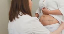 What You Need to Know About Revision Liposuction (& How to Avoid It)