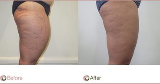 Cellulite Reduction Before & After | Cosmos Clinic