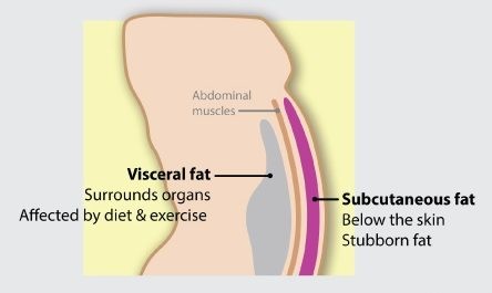 Exercise vs Liposuction - Understanding The Differences