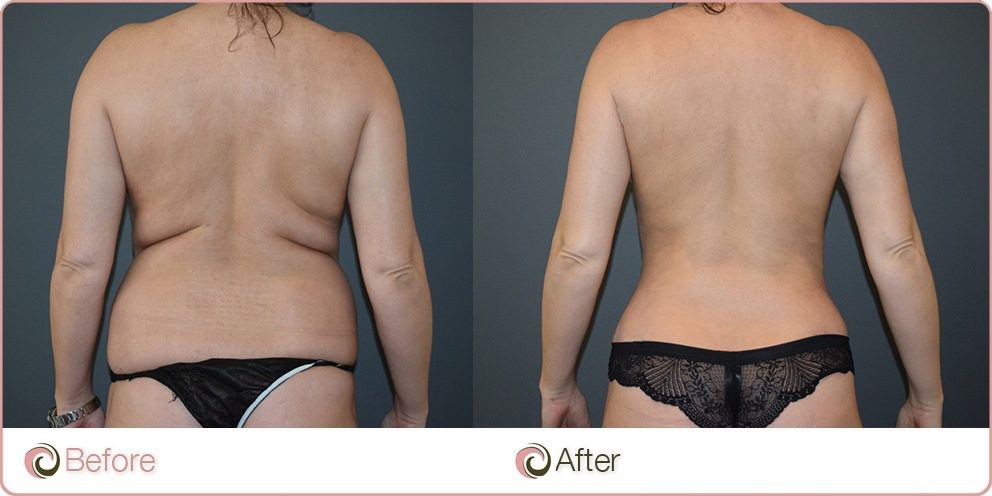 Female Back & Love Handles Liposuction Before & After.