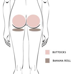 Buttock Liposuction / Buttock Reduction