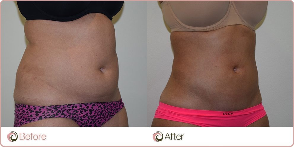 Liposuction Before and After Picture