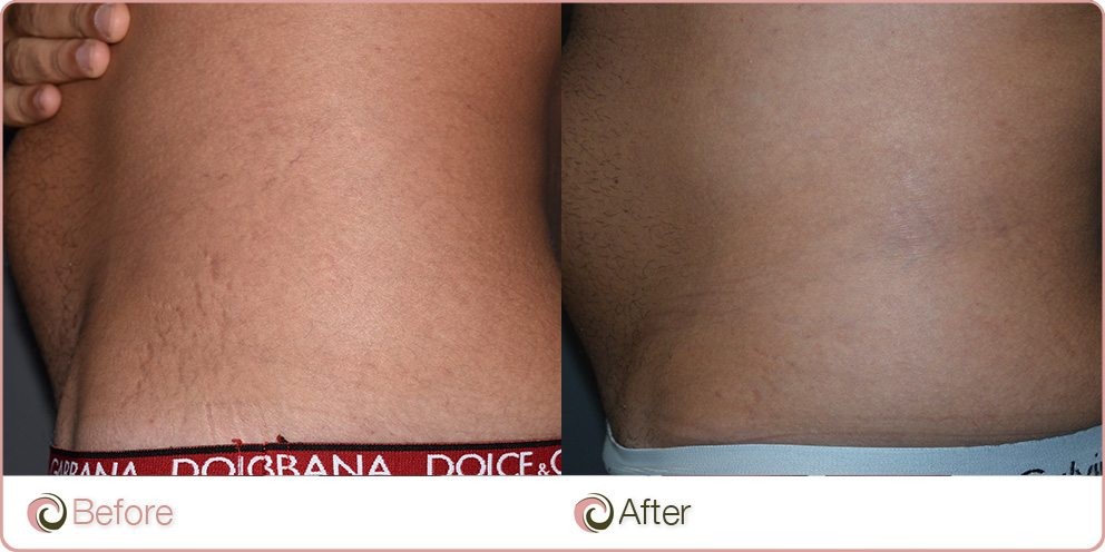 Platelet Rich Plasma Treatment on Stretch Marks before and after photos