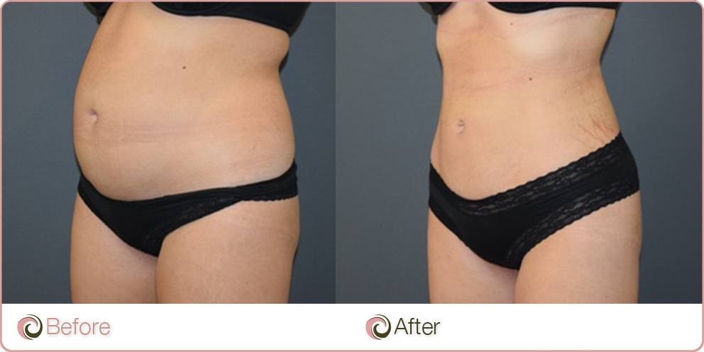 Liposuction episode, lipo 360 or tummy tuck ?