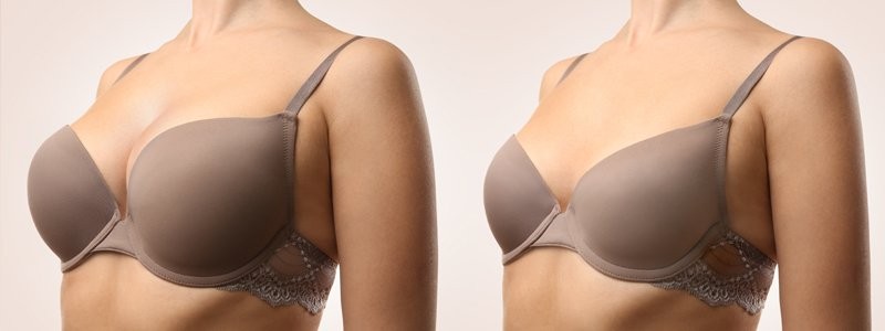 Choosing the Right Breast Enhancement: Fat Transfer or Implants