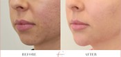 Chin Enhancement Before & After