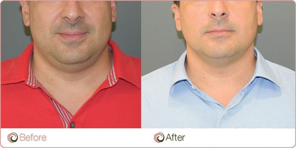 Fat Dissolving Injections to remove double chin