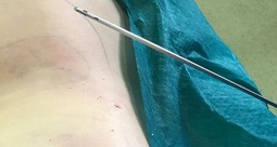 Differences between VASER and Laser Liposuction Results