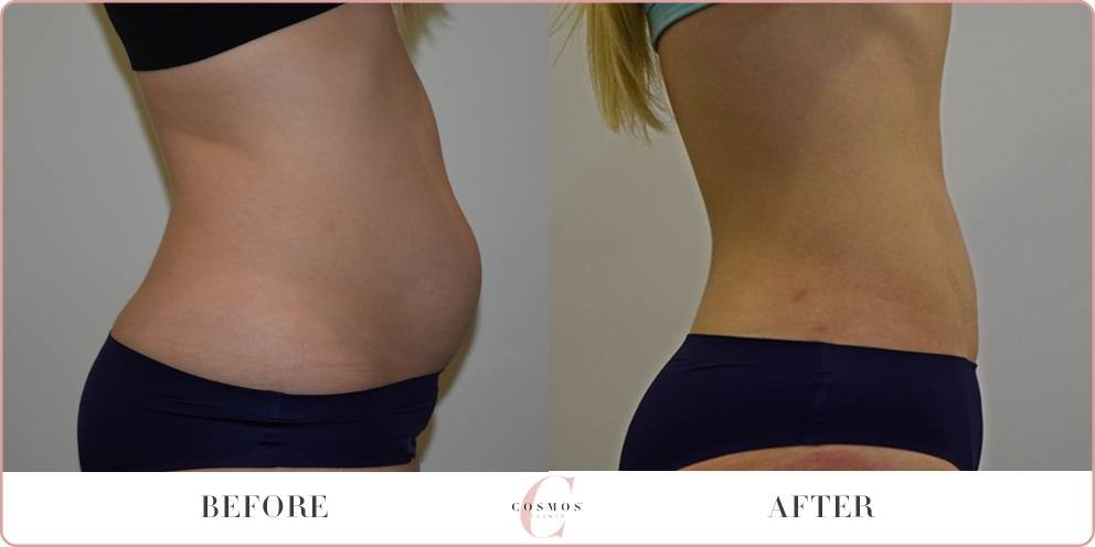 Female Tummy Liposuction Browse Before And After Results 