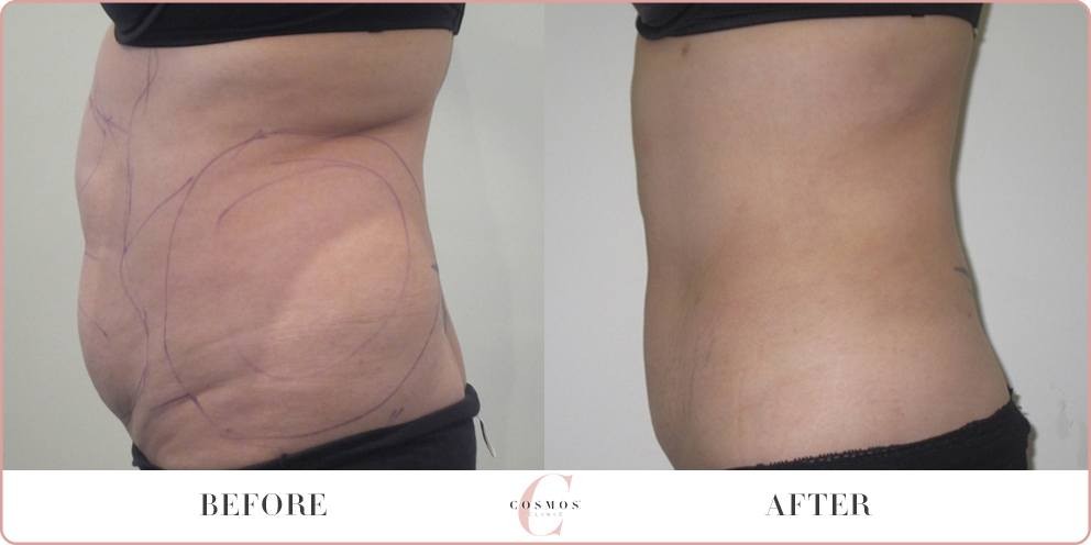 Chicago's Best Flank Fat Removal: Get Results Without Liposuction