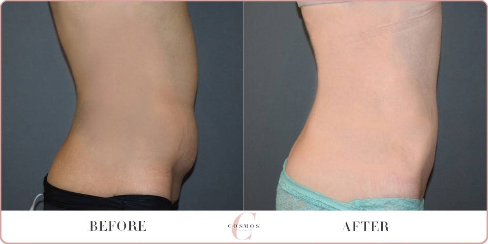 Female Tummy Liposuction Browse Before And After Results