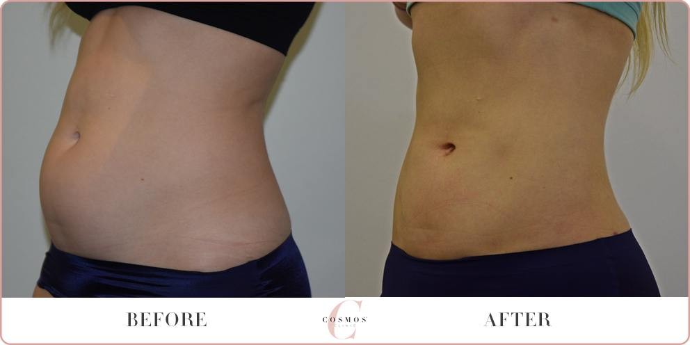 Liposuction Before And After Female Stomach