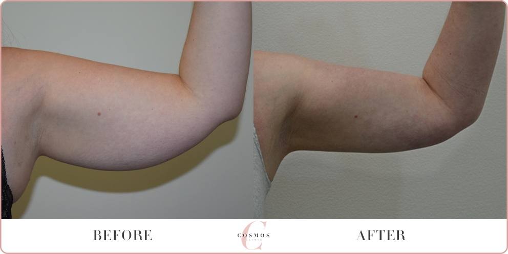 Arm Liposuction Before And After Explore The Outcomes Online