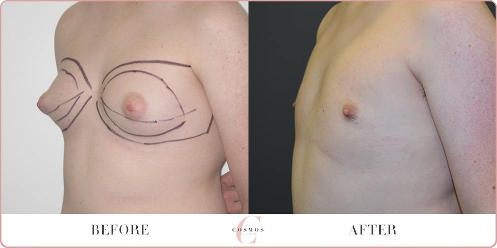 Copy 01 - Man boobs reduction surgery before & after 21, angle view