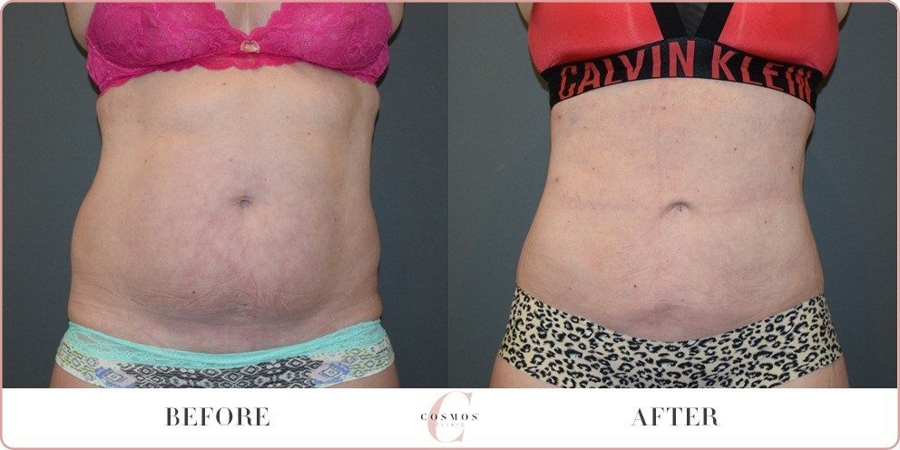 Mummy Tummy Liposuction Before And After Cosmos Clinic