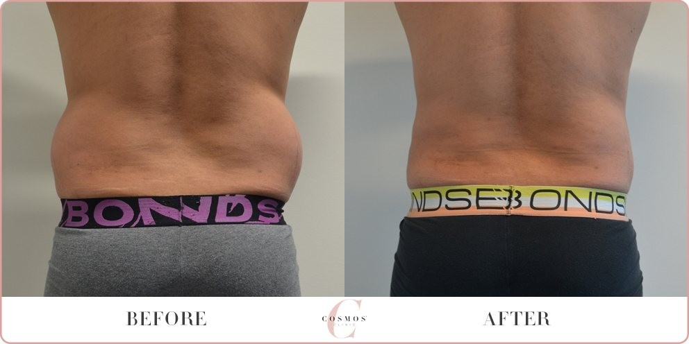 Before And After Love Handle Lipo Before And After