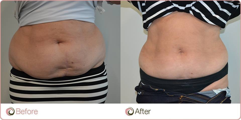 coolsculpting before & after