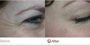 Anti Wrinkle