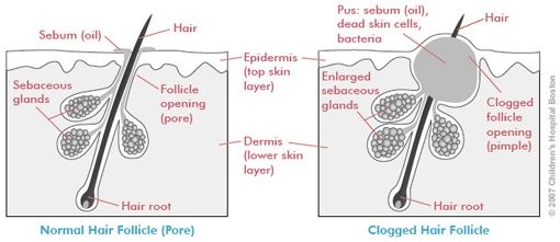 How is Acne Formed