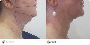 AG Neck