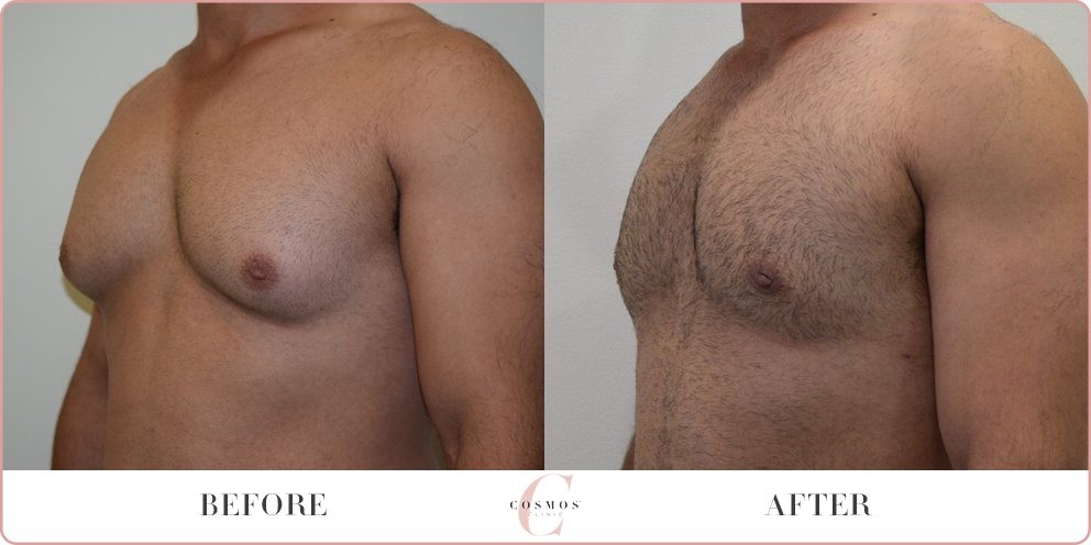 Man Boobs and How to Get Rid of Them - Allure Plastic Surgery