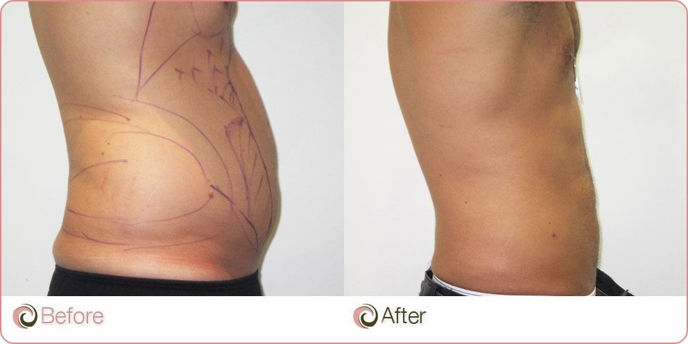 vaser liposuction before & after