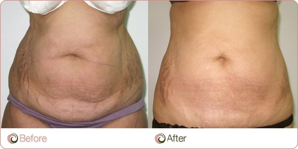 Can You Tighten Loose Skin After Losing Weight?