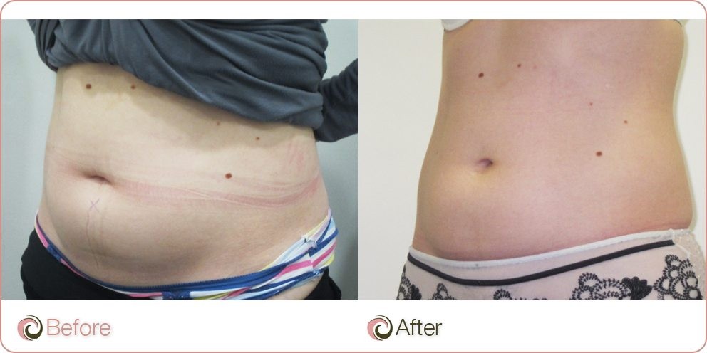 Coolsculpting side image