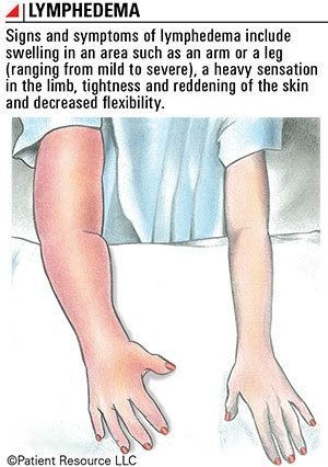 Lymphedema _new