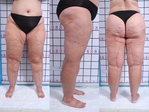 Lipedema Treatment With Liposuction Before After Photos