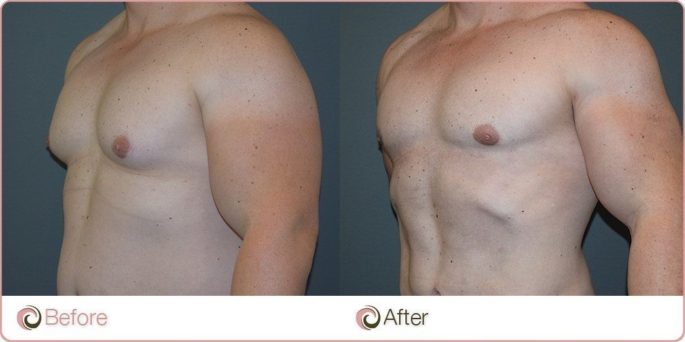 Droopy Nipple Steroid 💉💪Induced Gynecomastia Gland Removal By Dr