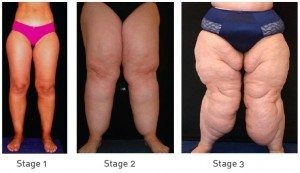 Stages Of Lipoedema