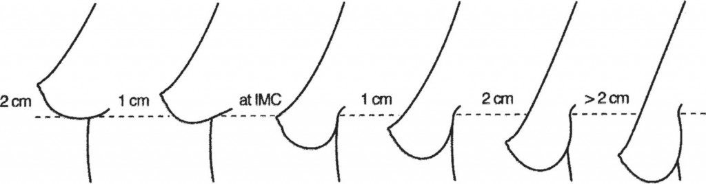 Breast ptosis